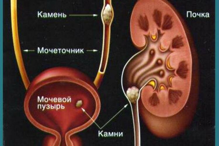 Мочекаменная болезнь рисунки