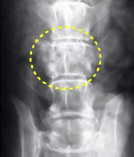 Рак позвоночника на рентгене фото