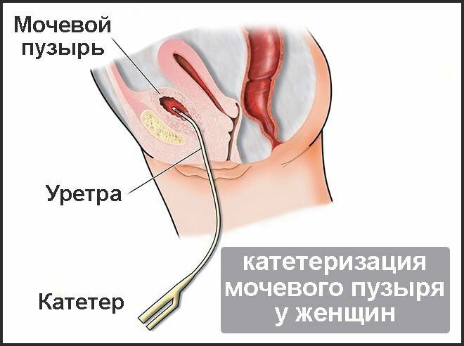 Катетеризация мочевого пузыря схема